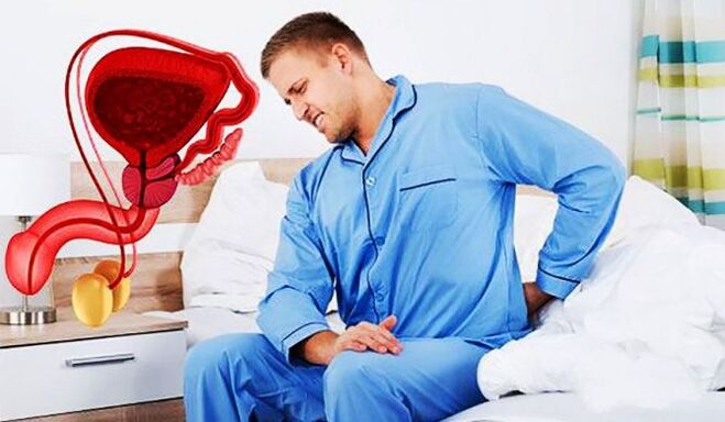 ból dolnej części pleców spowodowany zapaleniem prostaty