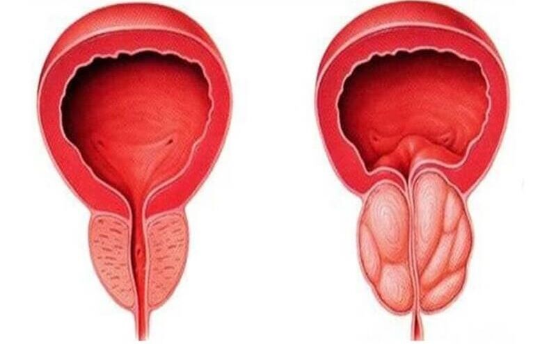 zdrowa i zapalona prostata z zapaleniem prostaty