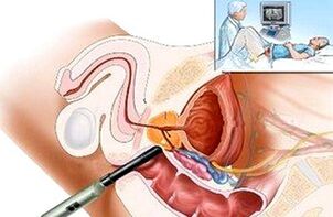 sposoby diagnozowania zapalenia gruczołu krokowego